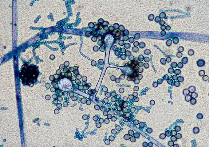 !Subestimadas y letales! Así son las infecciones invasivas por hongos