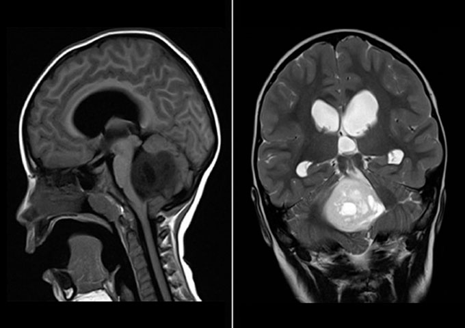 analisis-de-intervencion-interdisciplinaria-en-ninos-con-tumor-de-la-fosa-posterior.jpg